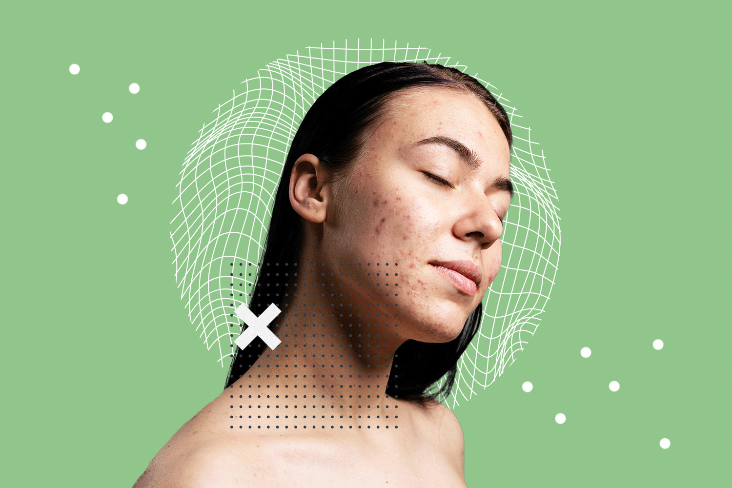 PCOS Acne: Symptoms and Treatments PCOS Acne: Symptoms and Treatments